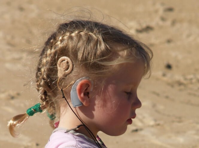 Cochlear Implant