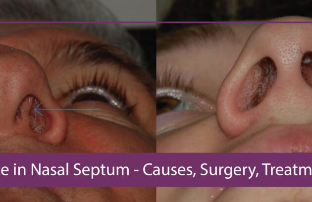 Hole in Nasal Septum - Causes, Surgery, Treatment