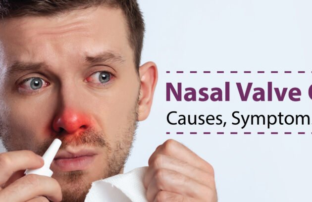 Nasal Valve Collapse Causes, Symptoms, Treatment