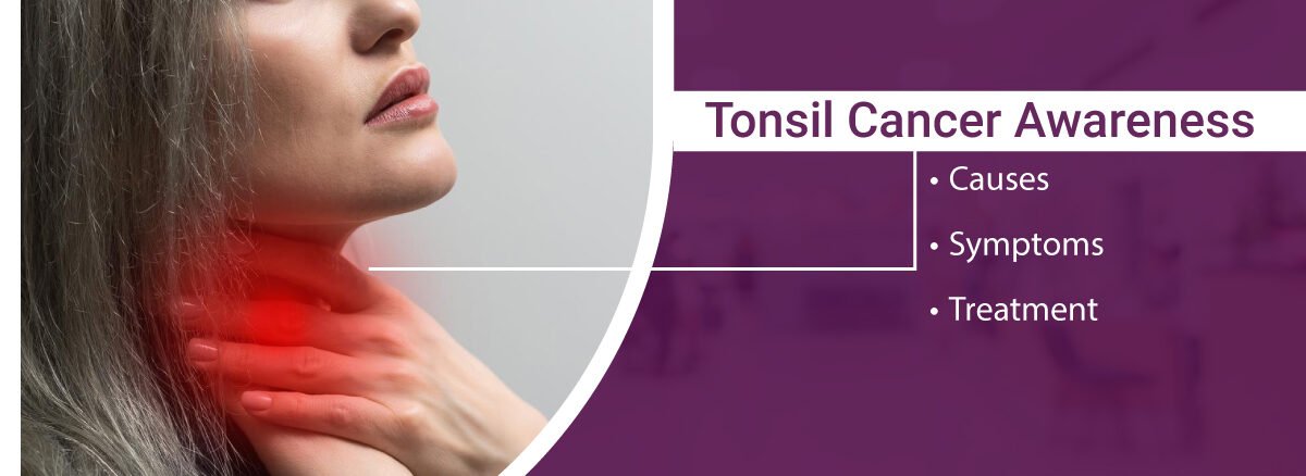 Tonsil-Cancer-Causes-Symptoms-Treatment