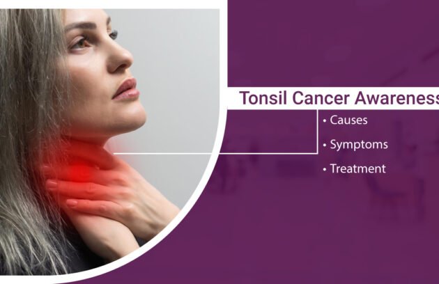 Tonsil-Cancer-Causes-Symptoms-Treatment