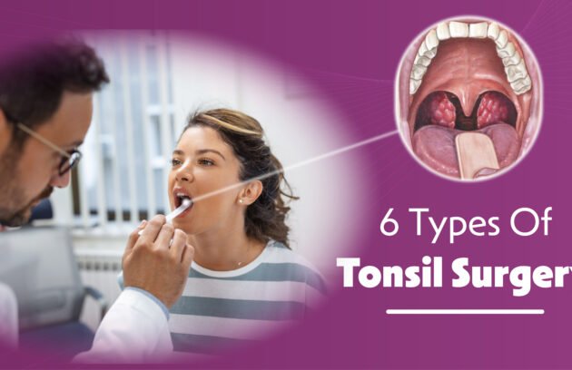 6 Types of Tonsil Surgery