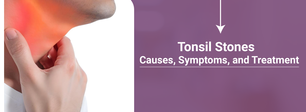 Tonsil-Stones-Causes-Symptoms-and-Treatment