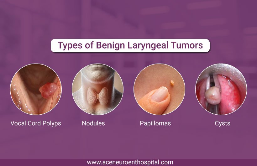 Types of Benign Laryngeal Tumors