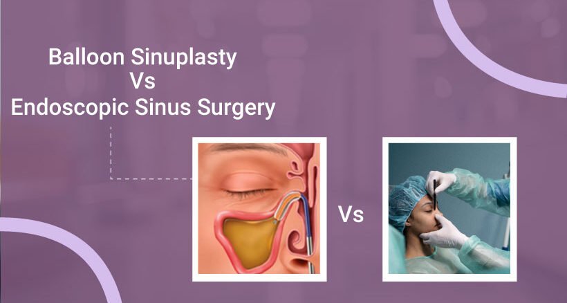 Balloon-Sinuplasty-vs-Endoscopic-Sinus-Surgery