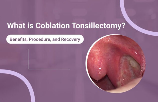 What is Coblation Tonsillectomy
