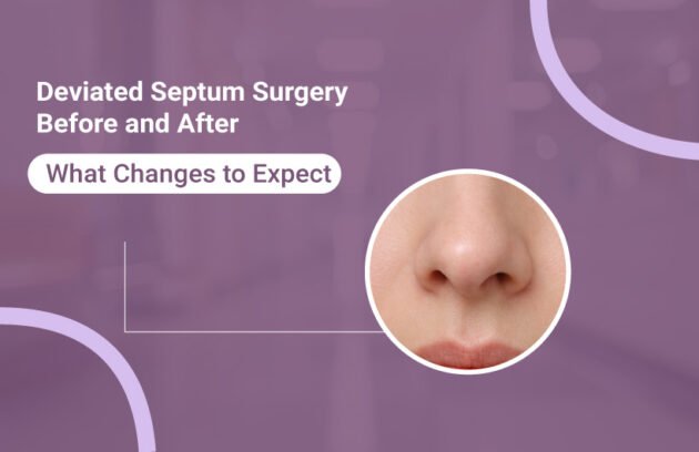 Deviated Septum Surgery Before and After