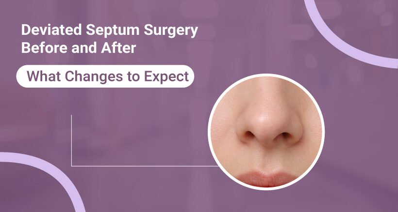 Deviated Septum Surgery Before and After