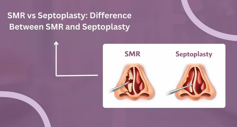 SMR vs Septoplasty Difference Between SMR and Septoplasty