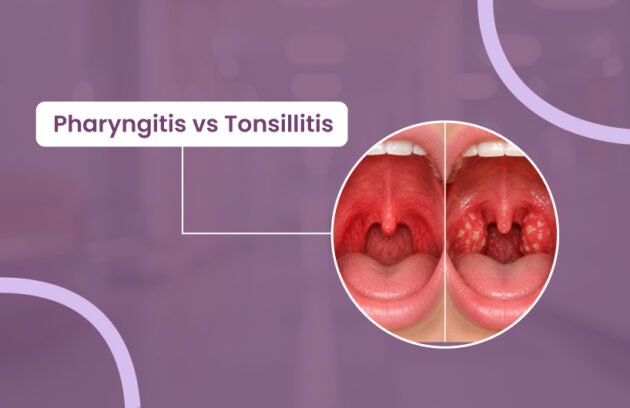 Pharyngitis vs Tonsillitis