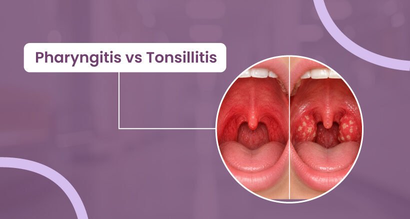 Pharyngitis vs Tonsillitis